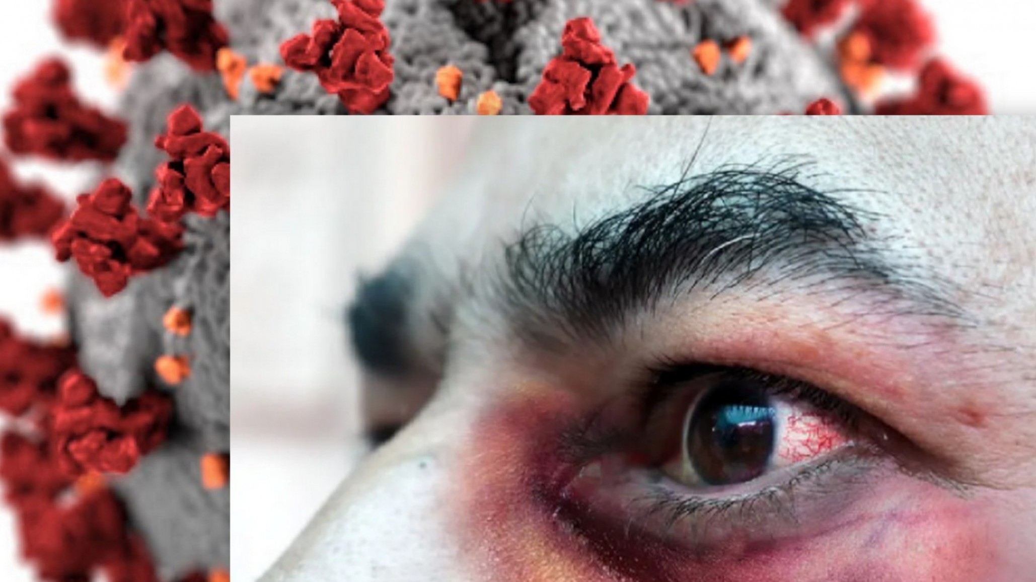 Murió por el “hongo negro” un hombre en Argentina