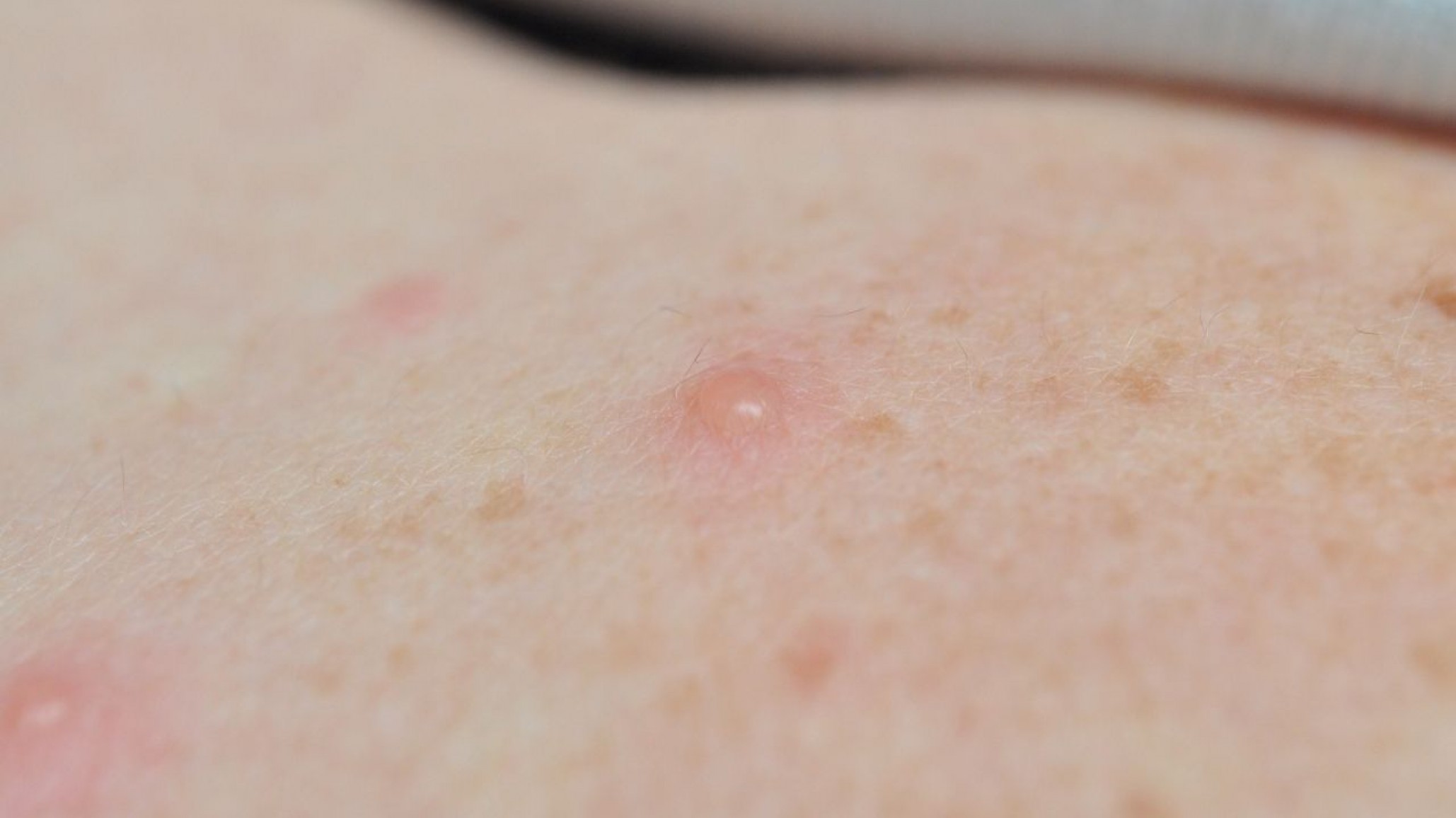 Viruela del mono: Se investiga el caso de un joven en Patagonia