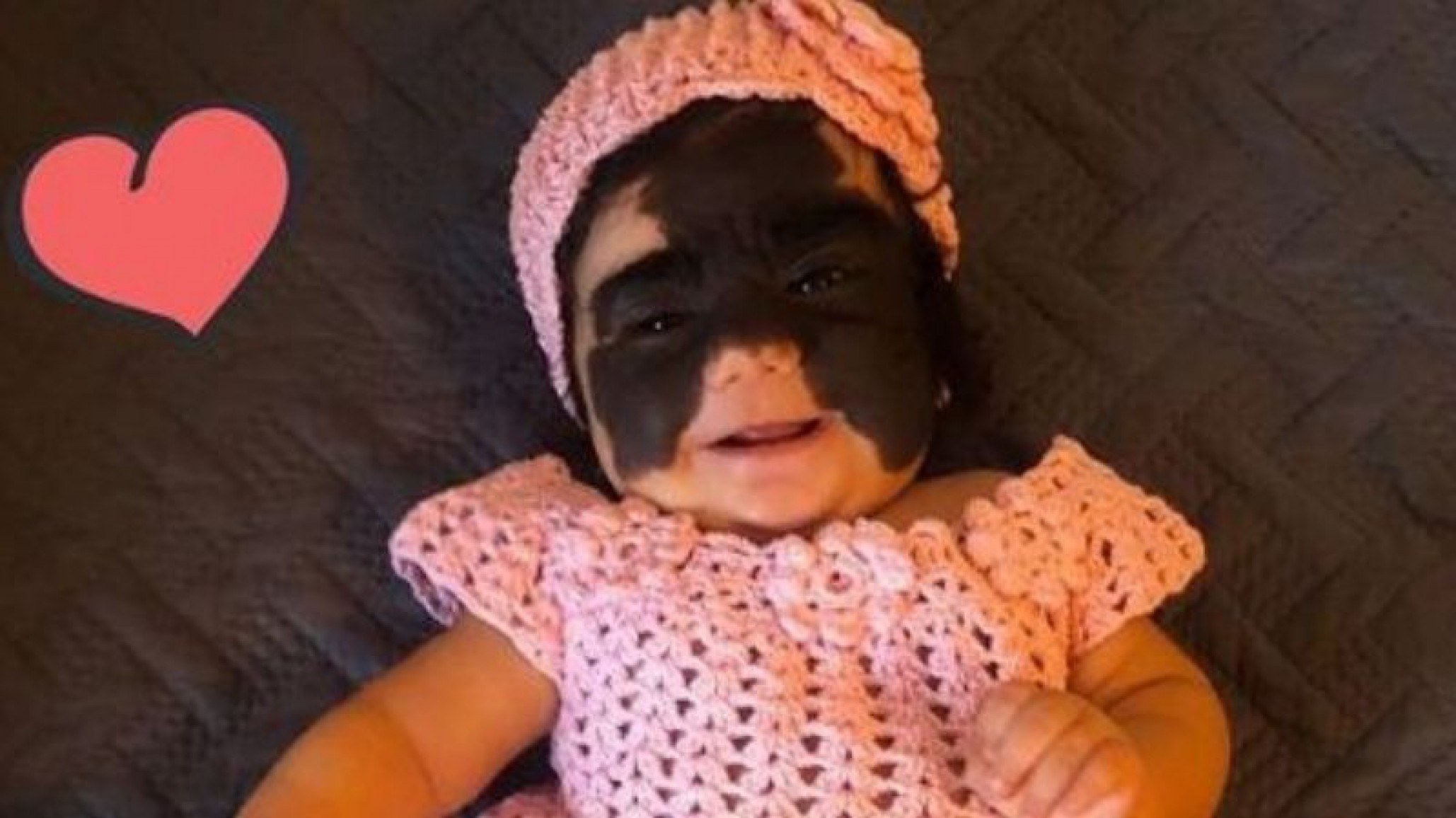 La bebé con un lunar gigante en la cara será tratada en Rusia