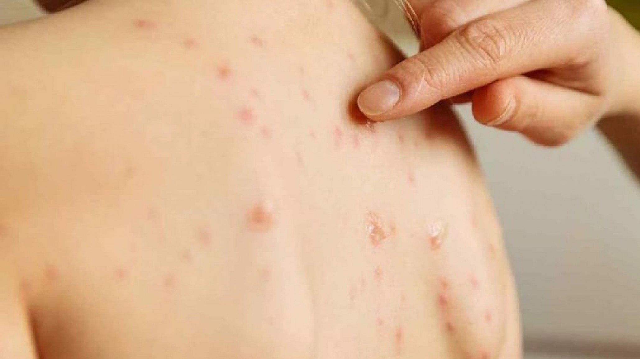 Confirmaron un caso de sarampión en CABA de una embarazada no vacunada