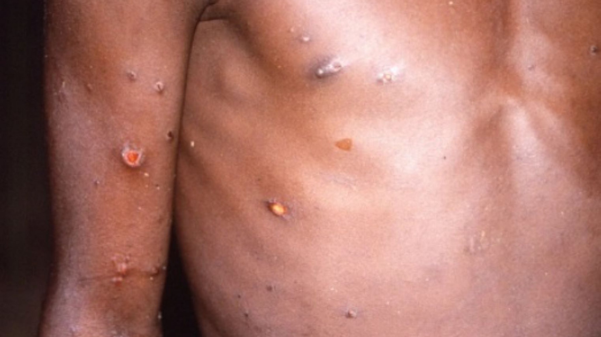 Viruela del mono: detectaron el primer caso sospechoso en la Argentina