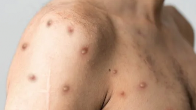 Viruela símica en Comodoro: Salud confirmó aislamiento y control de foco ante caso sospechoso