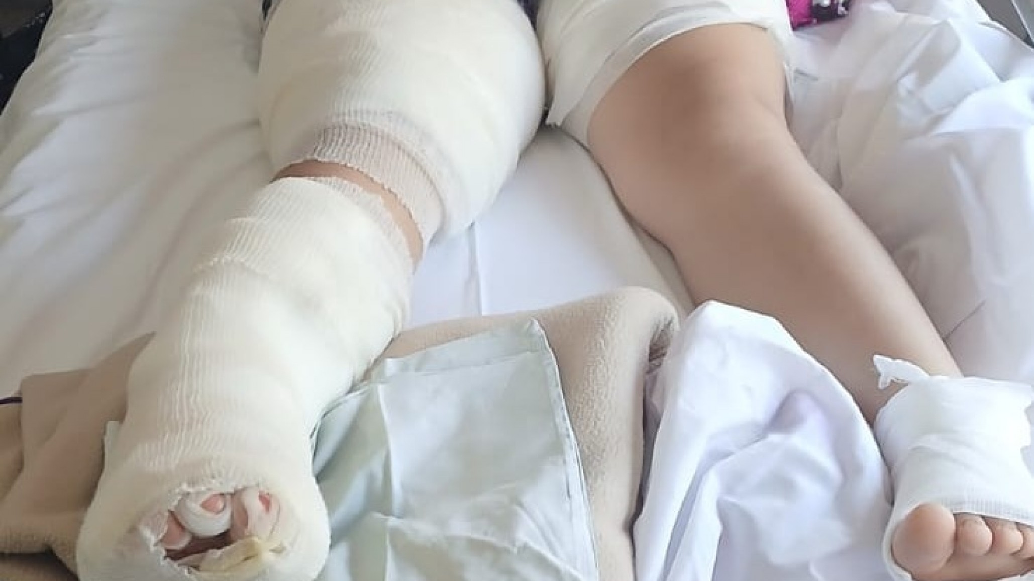 Natasha tiene 12 años, sufrió graves quemaduras y necesita una silla de ruedas para su recuperación