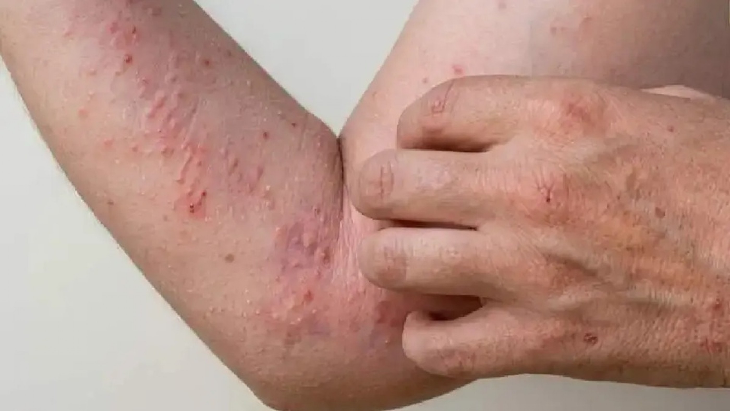 Sin freno: Se notificaron 85 nuevos casos de Chikungunya en apenas una semana